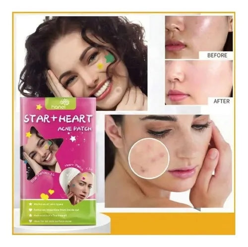 Parches De Estrellas Antiacne Hipo Alergicos De 72 Unidades